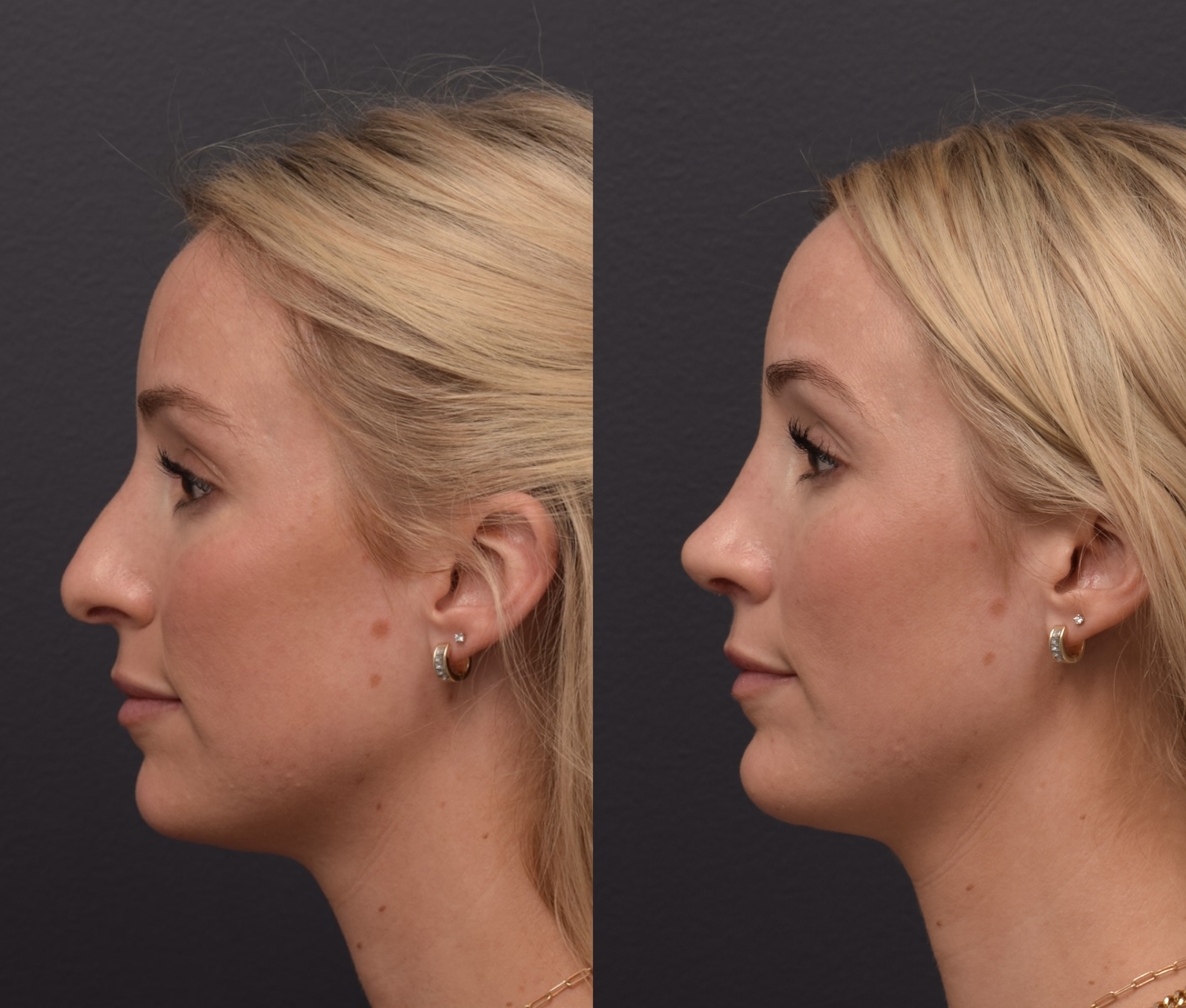 New Approach for Nose Job Without Breaking Bones