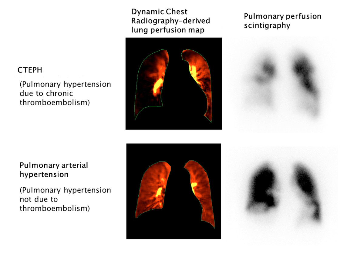 According to a study published in the peer-reviewed journal, Radiology, Dynamic Digital Radiography (DDR) of the chest (aka DCR) delivers similar efficacy as lung ventilation perfusion (V/Q) for the detection of chronic thromboembolic pulmonary hypertension (CTEPH).