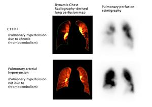 CTEPH Diagnosis with Dynamic Digital Radiography