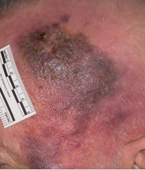 Patient B (Aged 82): Baseline