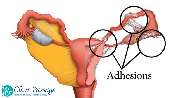 Adhesions are scar tissues that can form on the female reproductive organs, causing pain, limited function, and decreased fertility.