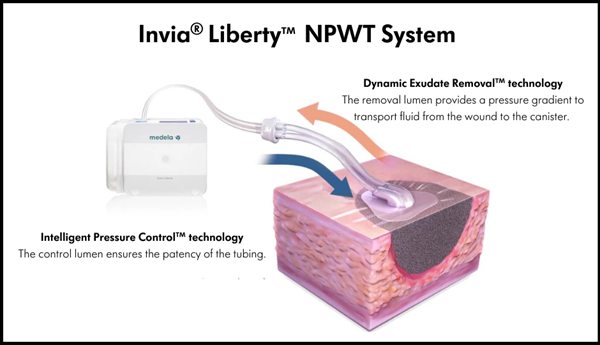 Invia® Liberty NPWT System