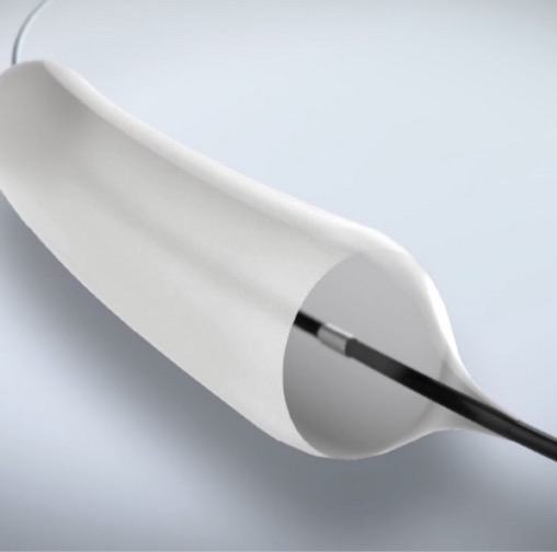 GIE Medical’s ProTractX3™ 3-Stage TTS DCB is a balloon coated with the chemotherapeutic agent paclitaxel. It is an investigational device in the U.S.