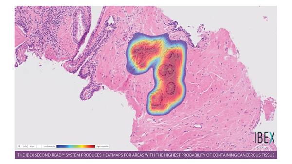 Ibex Second Read, now integrated into Inspirata's digital pathology platform, produces heatmaps for areas within an image with the highest probability of containing cancerous tissue.