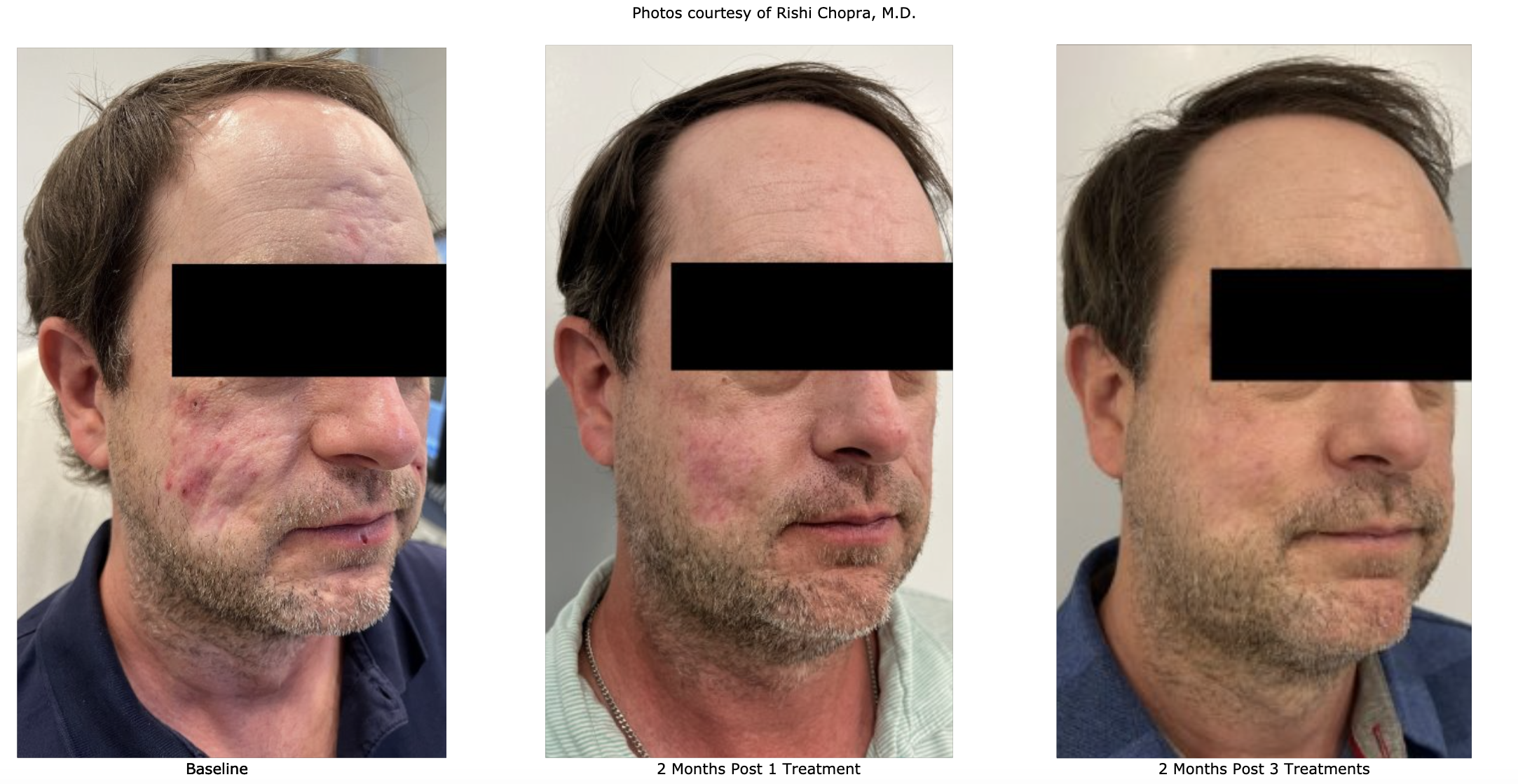 2 months post 3 Treatments