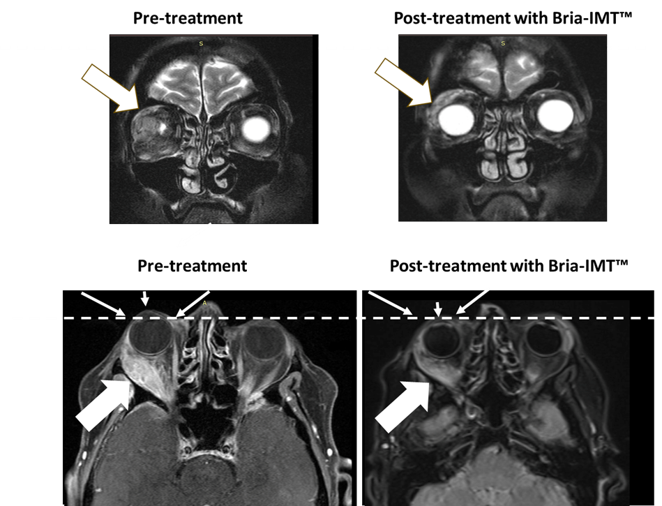 Magnetic resonance imaging (MRI) of the orbital tumor. The top left MRI image shows the tumor in the right orbit behind the eye with the eye not being visible pre-treatment. After treatment with the Bria-IMT regimen, the eye becomes visible (top right image) as it has regained its normal position. In the lower images, the dashed line represents normal margin of eye position with resolution of proptosis post treatment (small arrows) with the Bria-IMT regimen. Reduction in tumor is represented by large arrows.