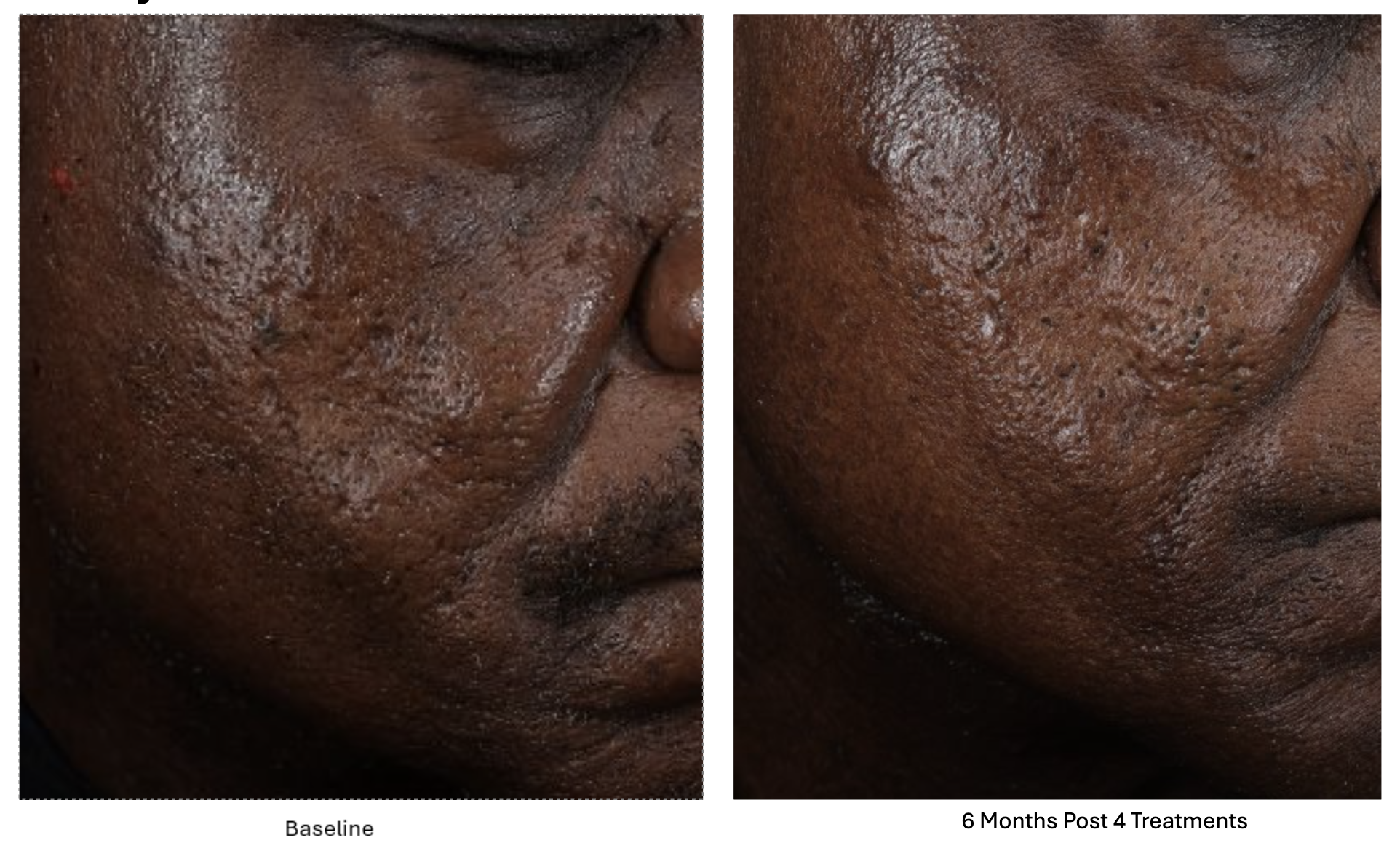 6 months post 4 treatments