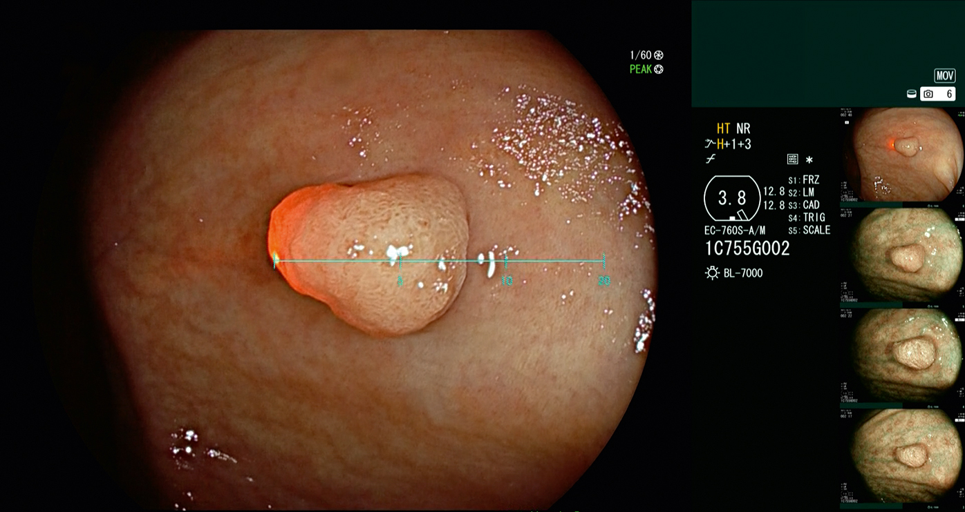 FUJIFILM Europe launches new software for SCALE EYE¹ a real time virtual scale function to aid endoscopists in estimating the size of lesions in the colon