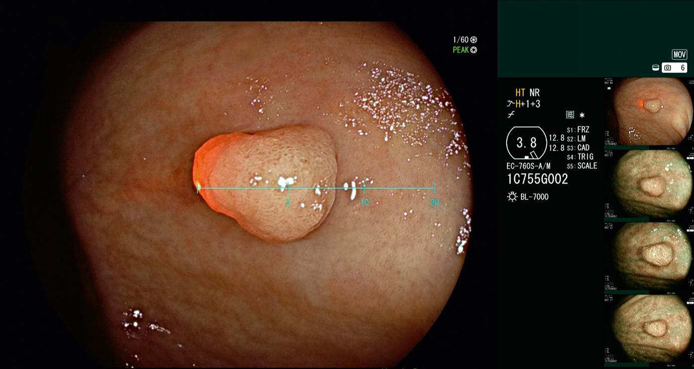 la scala virtuale è integrata nel campo visivo endoscopico.