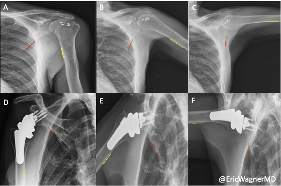Emory Healthcare Researchers Use Dynamic Digital Radiography to Compare Shoulder Improvement of Two Surgical Interventions for Massive Irreparable Rotator Cuff Tears