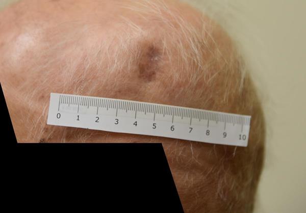 Patient A (Aged 93): 12 weeks of treatment