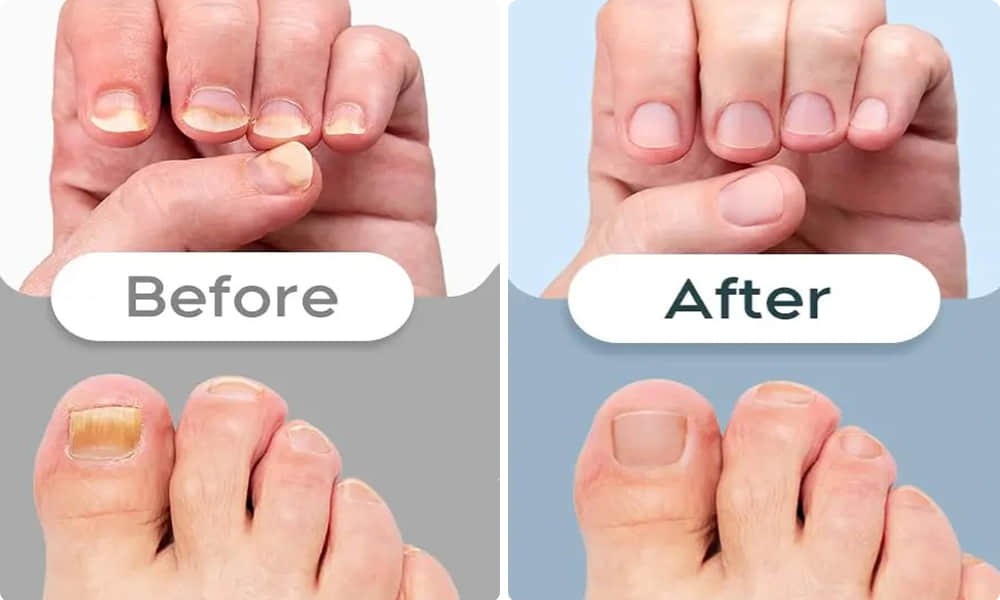 Welnax Bioclear Before and After