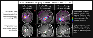 Initial treatment imaging from first patient treated in the ReSPECT-GBM Phase 2b trial