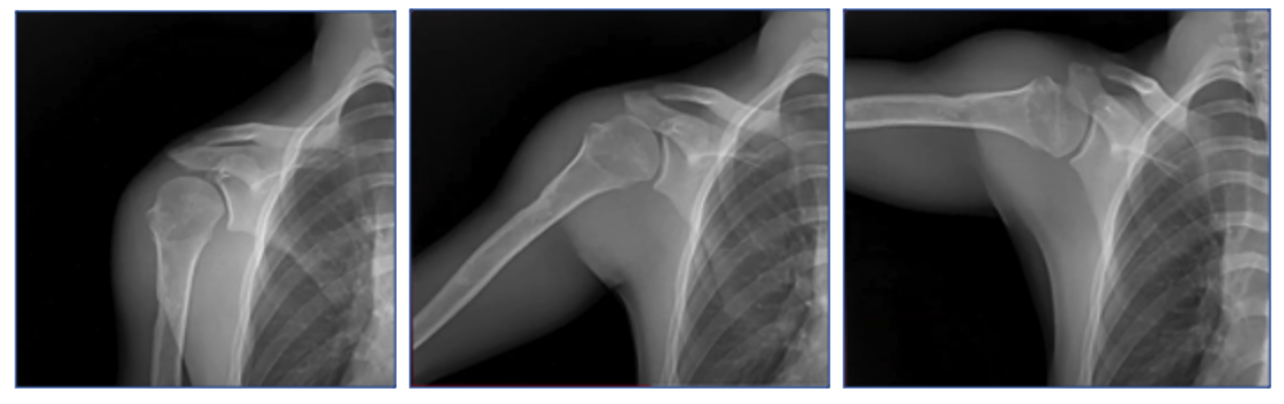 Emory Researchers Demonstrate the Power of Dynamic Digital Radiography to Quantify Functional Outcomes After Total Shoulder Arthroplasty