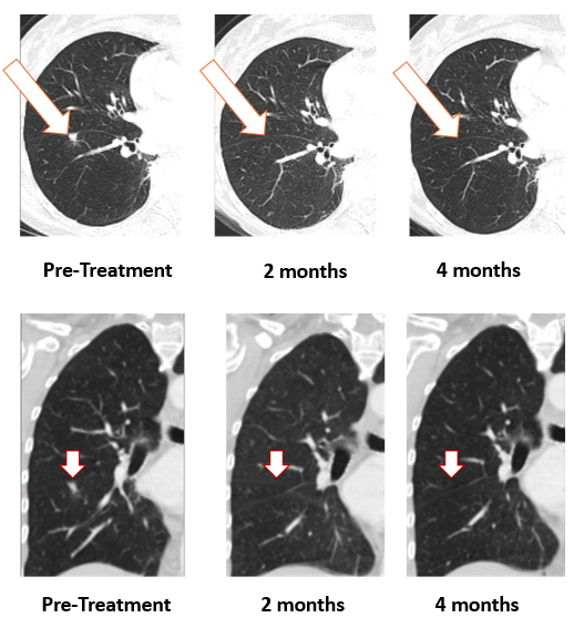 Treatment with Bria-OTS monotherapy resulted in <percent>100%</percent> resolution of a breast cancer tumor in the lung of the metastatic breast cancer (MBC) patient following 2 months of therapy and confirmed at 4 months of therapy (axial and coronal views)
