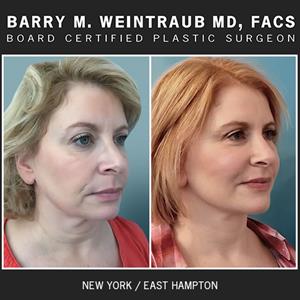 Facelift Results By Dr. Barry Weintraub