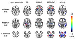 SynuSight Biotech, ABLi Therapeutics and XingImaging Announce Strategic Collaboration to Implement Alpha-Synuclein PET Imaging into Clinical Trials Evaluating Risvodetinib as a Disease-modifying Therapy for Parkinson’s Disease