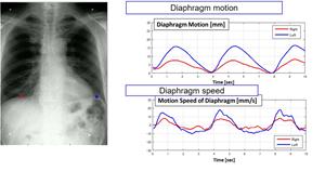Dynamic Digital Radiography for thoracic and pulmonary imaging