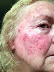 Understanding and Treating Rosacea: What You Need to Know