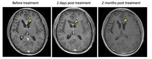 NeuExcell Therapeutics Reports Encouraging Clinical Results with World’s First In Situ Conversion Therapy for Malignant Glioma
