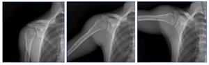 Emory Researchers Demonstrate the Power of Dynamic Digital Radiography to Quantify Functional Outcomes After Total Shoulder Arthroplasty
